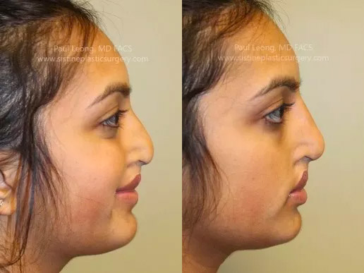 nose jobs before and after